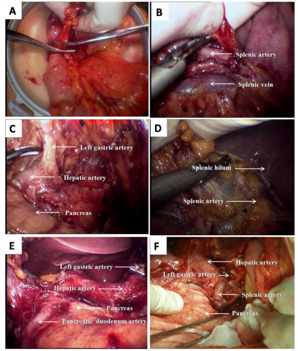 Three-Step Hand-Assisted Laparoscopic D2 Radical Gastrectomy for Chinese Obese Patients: A Highly Ef