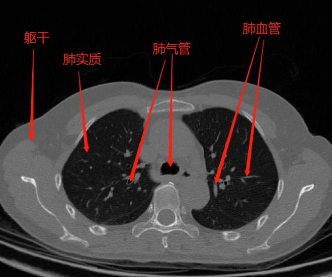 肺CT.png