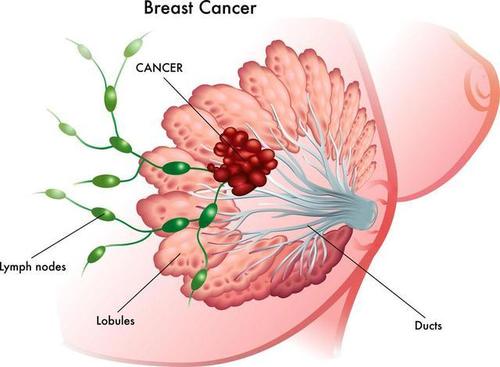 乳腺癌应该如何预防