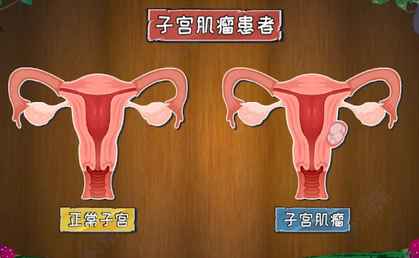 子宫肌瘤是怎么引起的？