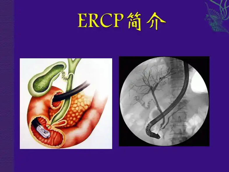 ERCP技术(胆道梗阻治疗)手术