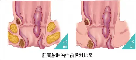 肛周脓肿日常该如何护理?