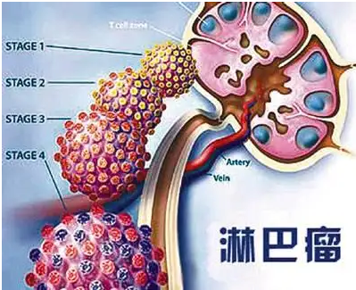 淋巴瘤治疗的注意事项