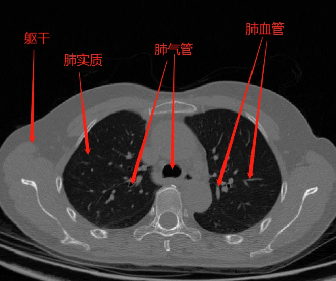 肺部ct可以查出哮喘吗