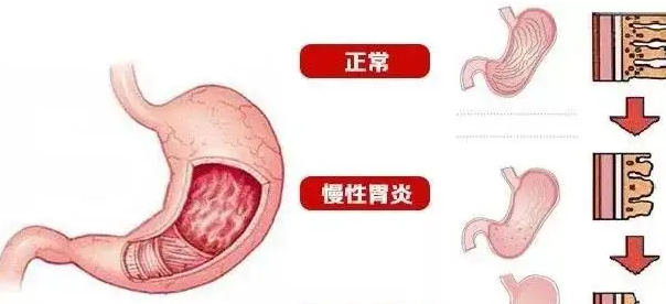 成都慢性胃炎和急性胃炎有什么区别.png