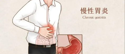 得了慢性胃炎怎么办?