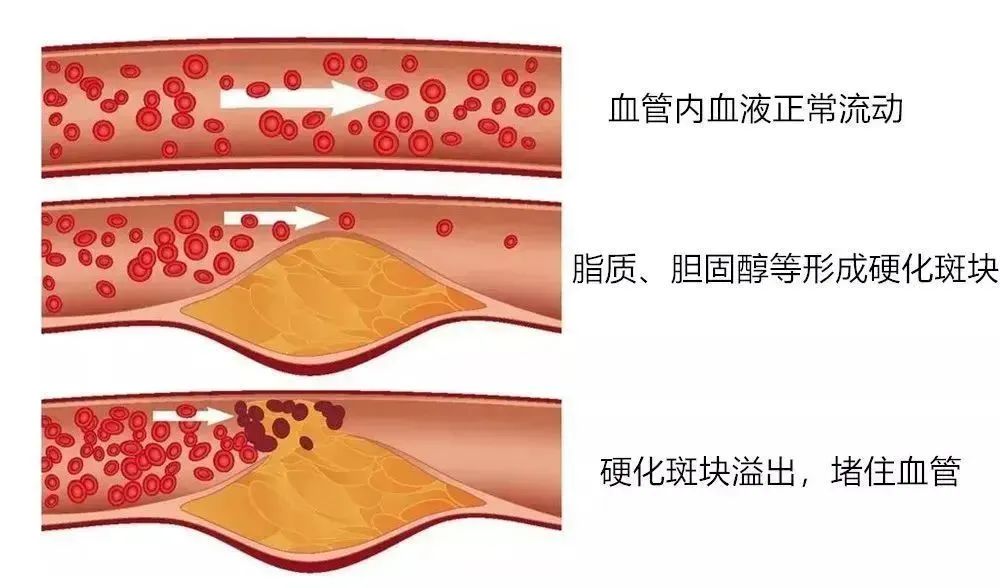 高血脂的症状及危害|千万别忽视血管健康！高血脂的人如何管理饮食最科学？