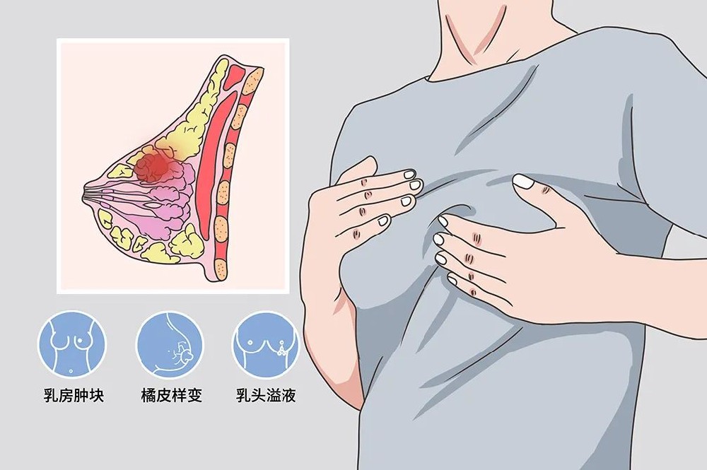 乳腺腺病彩超查最早出现的症状|乳癌高发的年代 女人如何打响乳房保卫战？