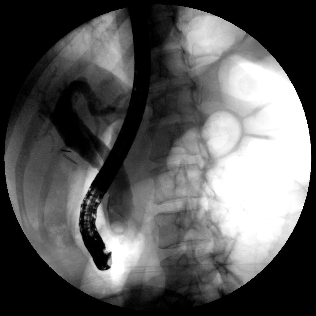 消化内镜中心经内镜逆行胰胆管造影（ERCP）