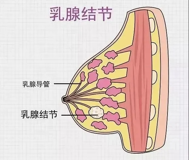 乳房结节怎么散结最快乳腺低回声结节bi-rads3类|你的乳腺结节，有可能是被气出来的！