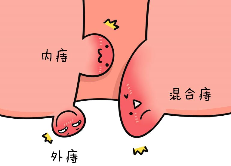 pph微创手术治疗痔疮医院哪家好