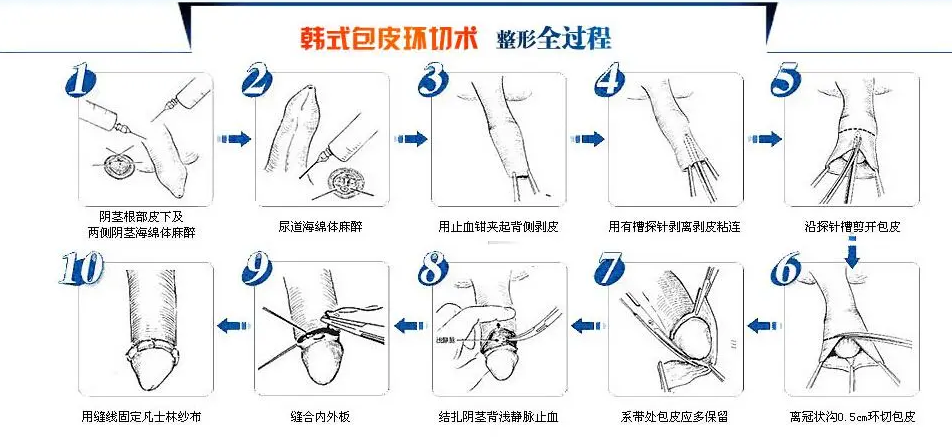 成都包皮手术哪家好