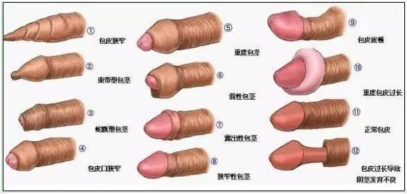 成都包皮手术暑期儿童包皮专享福利：卸下“包”袱真是“泰裤辣”