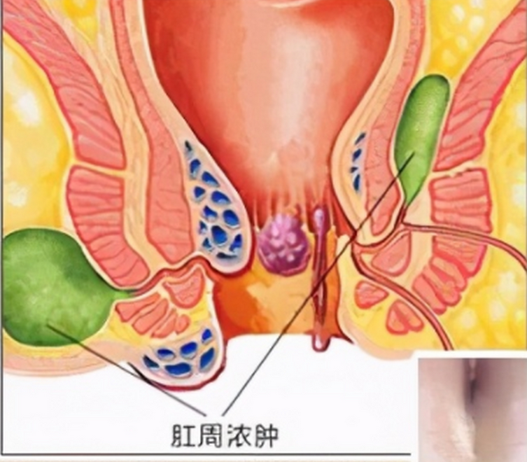 肛门长了个包你知道怎么回事吗？川北医学院附属成都新华医院为你揭开真相
