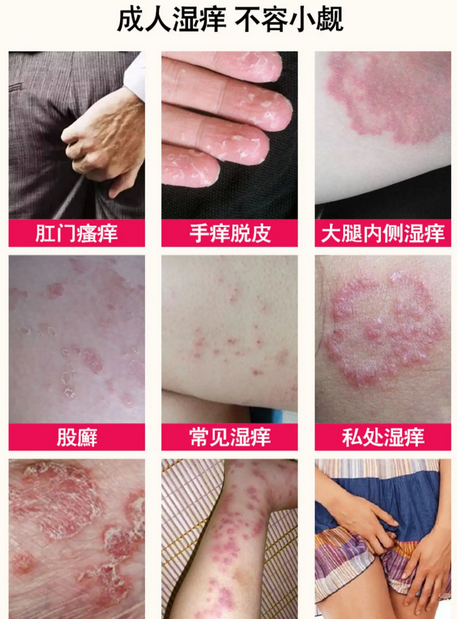 肛门周围瘙痒是什么原因导致|肛门周围瘙痒新华医院为您支招