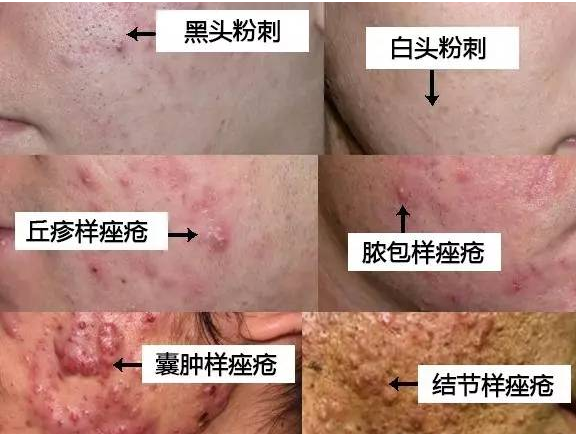 结节性痤疮如何治疗|结节性痤疮的治疗方法简单有效