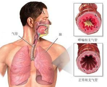 止咳化痰治疗气管炎，川北医学院附属成都新华医院为您支招