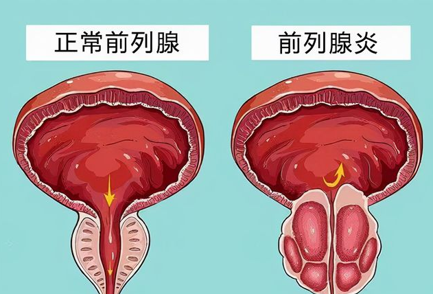 前列腺炎吃什么药效果好见效快|川北医学院附属成都新华医院教你如何应对前列腺炎