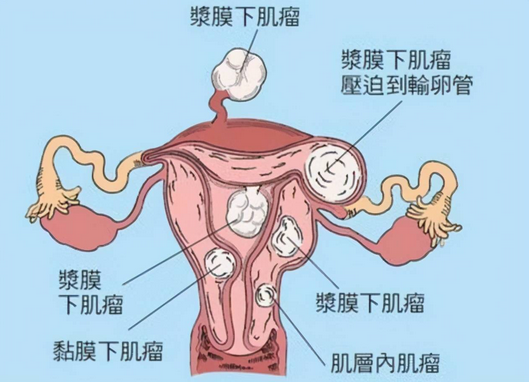 子宫肌瘤是什么原因导致的？川北医学院附属成都新华医院为您解答