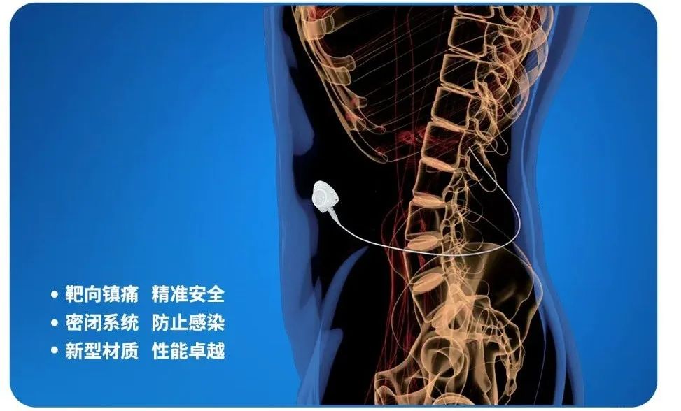 肿瘤科镇痛新技术——鞘内药物输注系统植入术（IDDS）